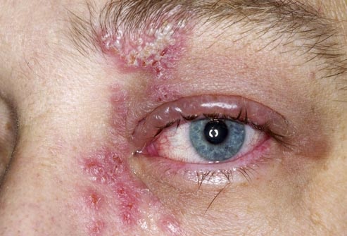 PRinc_photo_of_shingles_rash_on_eye.jpg