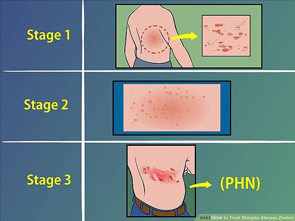 aid525941-v4-900px-Treat-Shingles-(Herpes-Zoster)-Step-2.jpg