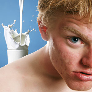 milk-good-for-acne-1.jpg