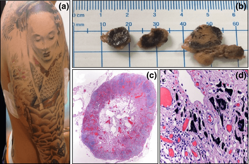 Figure-1-Tattoos-predominantly-black-on-the-right-arm-b-black-sentinel-lymph-nodes-1.png