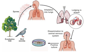 Solutions.Pigeon droppings.Human 1.jpg