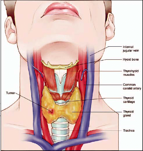 Thyroid-cancer.gif