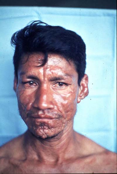 leprosy-who2.jpg