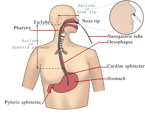 nasogastric_tube.jpg