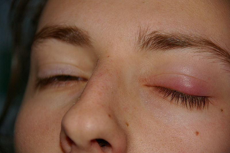 800px-Chalazion.JPG