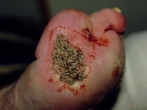 Maggots therapy 1.jpg