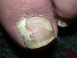 onychomycosis_white.jpg