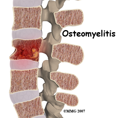 child_back_pain_osteomyelitis.jpg