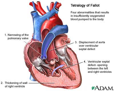 tetralogy-of-fallot.jpg