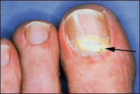 proximal-subungual-onychomycosis.jpg