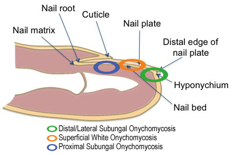 onychomycosis (1).jpg