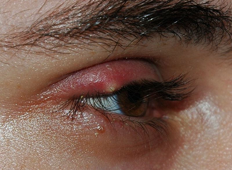 800px-Stye02.jpg