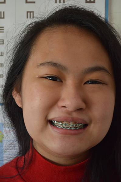 0429Braces1.jpg