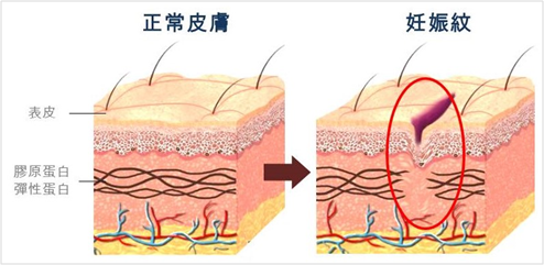 妊娠紋是什麼？正常皮膚與妊娠紋皮膚的表皮層、真皮層解構圖示