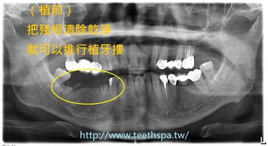 新禾牙醫診所 植牙 專業植牙 人工植牙 微創植牙 無痛植牙 新禾齒科 新浪博客
