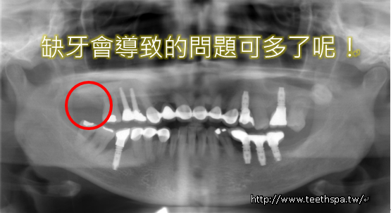 舒眠植牙新禾牙醫2.PNG