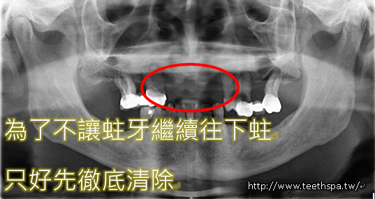 怕痛微創植牙新禾牙醫2.PNG