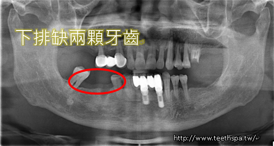 植牙牙齒健康1.PNG