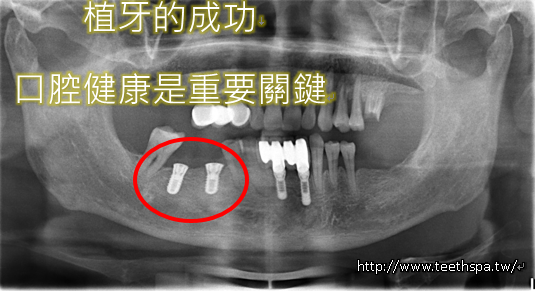 植牙牙齒健康4.PNG