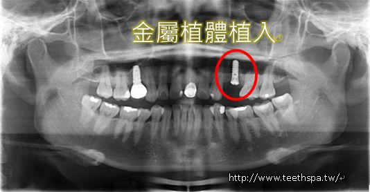 人工植牙經驗3.JPG