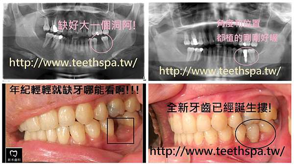 快速植牙 免驚慌 新禾牙醫診所 植牙 專業植牙 人工植牙 微創植牙 無痛植牙 全口植牙 台北植牙 快速植牙