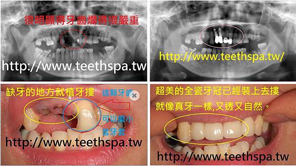 植牙不再讓你門牙空蕩蕩 新禾牙醫診所 植牙 專業植牙 人工植牙 微創植牙 無痛植牙 全口植牙 台北植牙