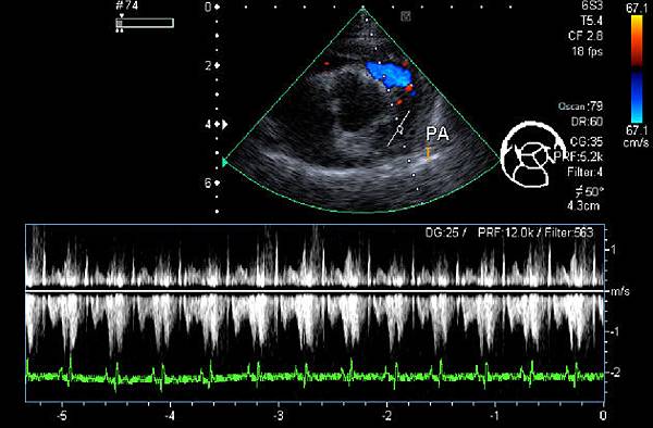 09_肺動脈右心房狹窄輕微逆流.jpg