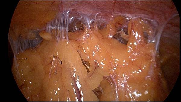 Omental Adhesiolysis HT1.jpg Omental Adhesiolysis HT1.jpg