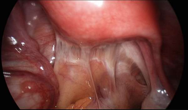 筋膜沾黏 讓你全身毛病連連 無恙森林all Is Well 痞客邦