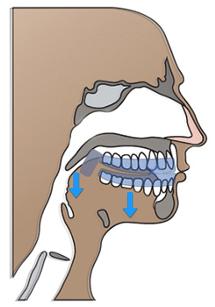 牙套示意圖.png 牙套示意圖.png