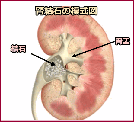 腎結石