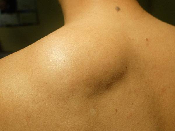 到底為什麼會得脂肪瘤 怎樣才能預防脂肪瘤.jpg 到底為什麼會得脂肪瘤 怎樣才能預防脂肪瘤.jpg