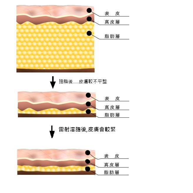 溶脂前後