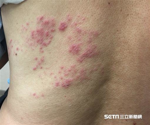 帶狀皰疹疫苗+汗皰疹/唇皰疹/蕁麻疹/有一種皮膚病,很教人討 帶狀皰疹疫苗+汗皰疹/唇皰疹/蕁麻疹/有一種皮膚病,很教人討