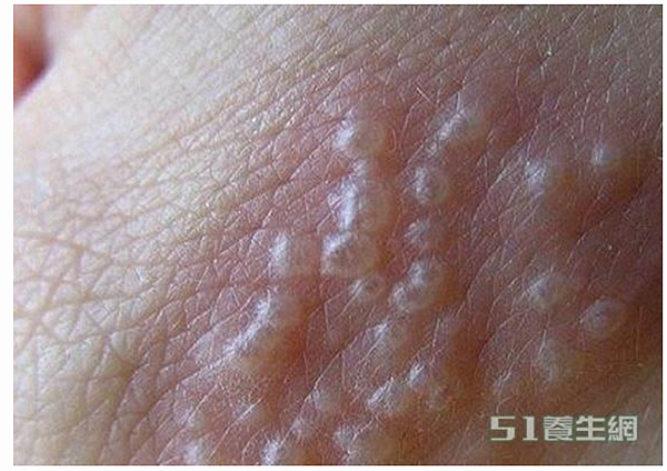 帶狀皰疹疫苗+汗皰疹/唇皰疹/蕁麻疹/有一種皮膚病,很教人討 帶狀皰疹疫苗+汗皰疹/唇皰疹/蕁麻疹/有一種皮膚病,很教人討