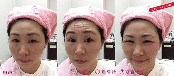 抬頭紋魚尾紋肉毒淚溝眼袋20151130術前記錄.jpg