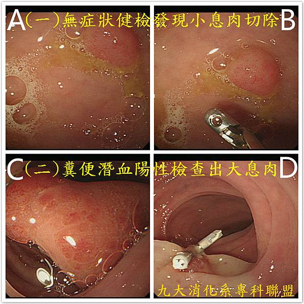 息肉與大腸癌(1).jpg