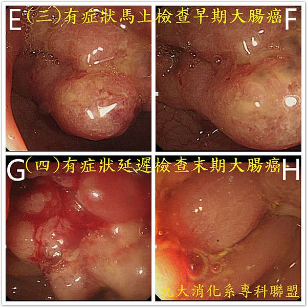 息肉與大腸癌(2).jpg