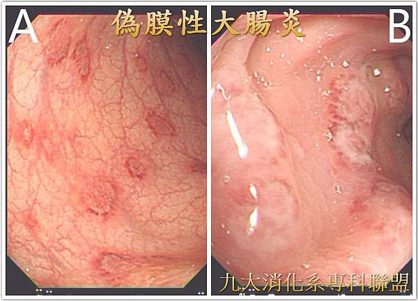 偽膜性大腸炎.jpg