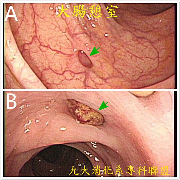 大腸憩室.jpg