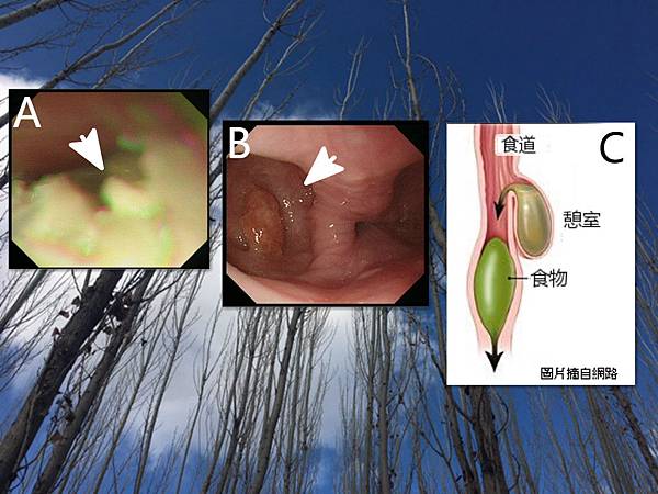 食道憩室(部落格).jpg