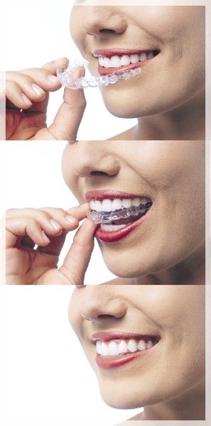 invisalign123.jpg