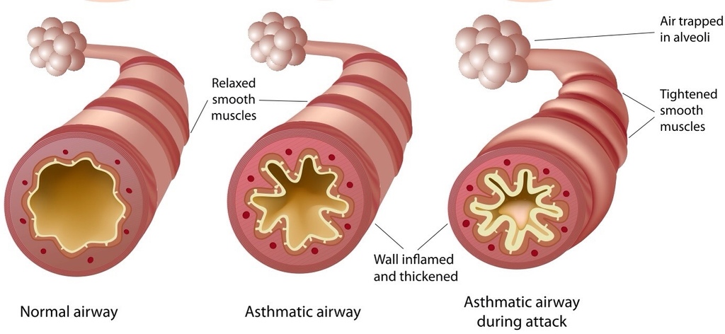 asthma.jpg