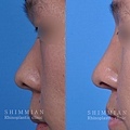 隆鼻术2.jpg