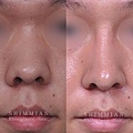 隆鼻术1.jpg