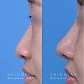 歪鼻手术2.jpg
