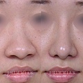 歪鼻手术1.jpg