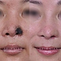 鼻子重建1.jpg