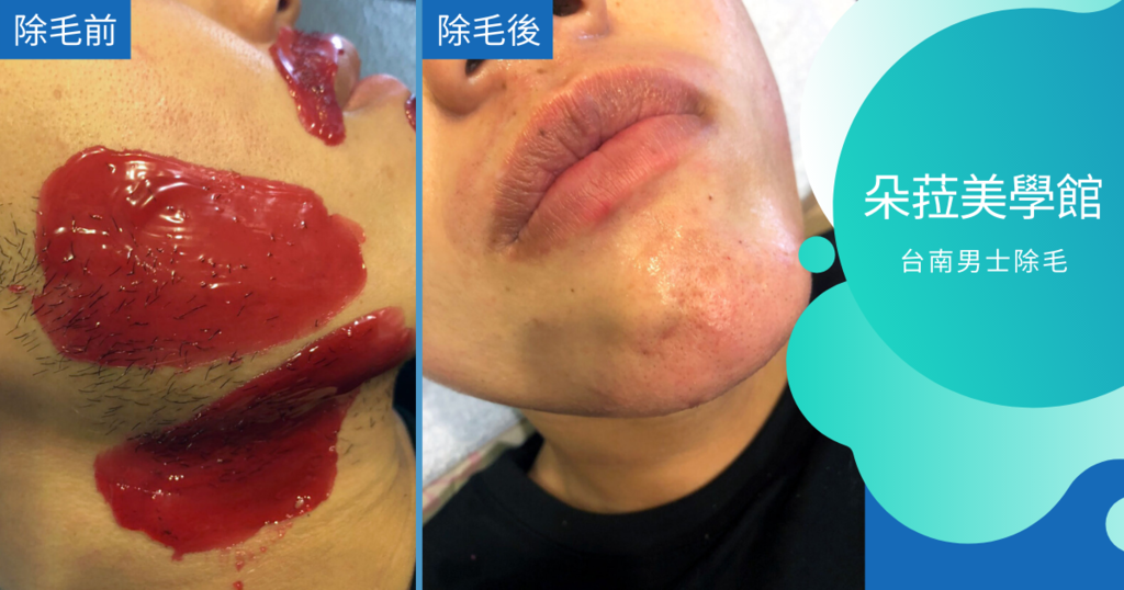 【台南除毛】朵菈美學館|台南男士除毛推薦|熱臘除毛男生分享|台南南區除毛ppt|好友除毛初體驗