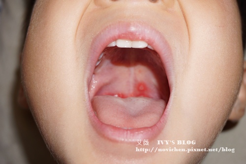 安安腸病毒_12.JPG 安安腸病毒_12.JPG